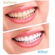 Избелващи ленти за зъби, Комплект 14 броя