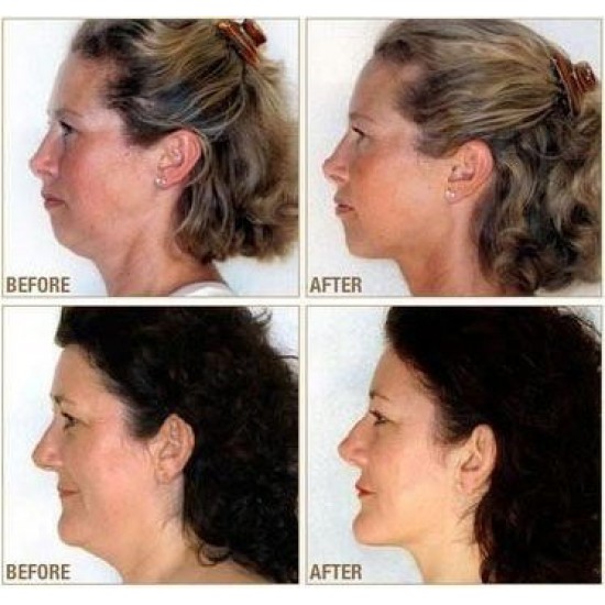  Уред за премахване на двойна брадичка NECKLINE SLIMMER